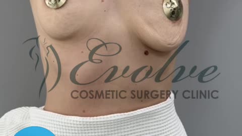 Breast Lift with Augmentation | Before & After Results @evolvecosmeticclinic