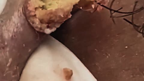 Satisfying massive blackhead removal #2