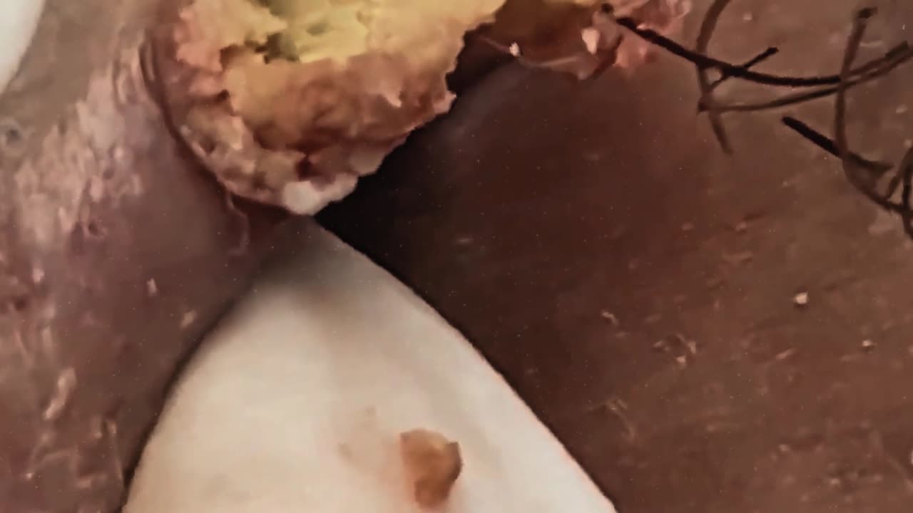 Satisfying massive blackhead removal #2