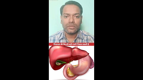 पित्ताशय की कितनी बड़ी पथरी निकल सकती है ।