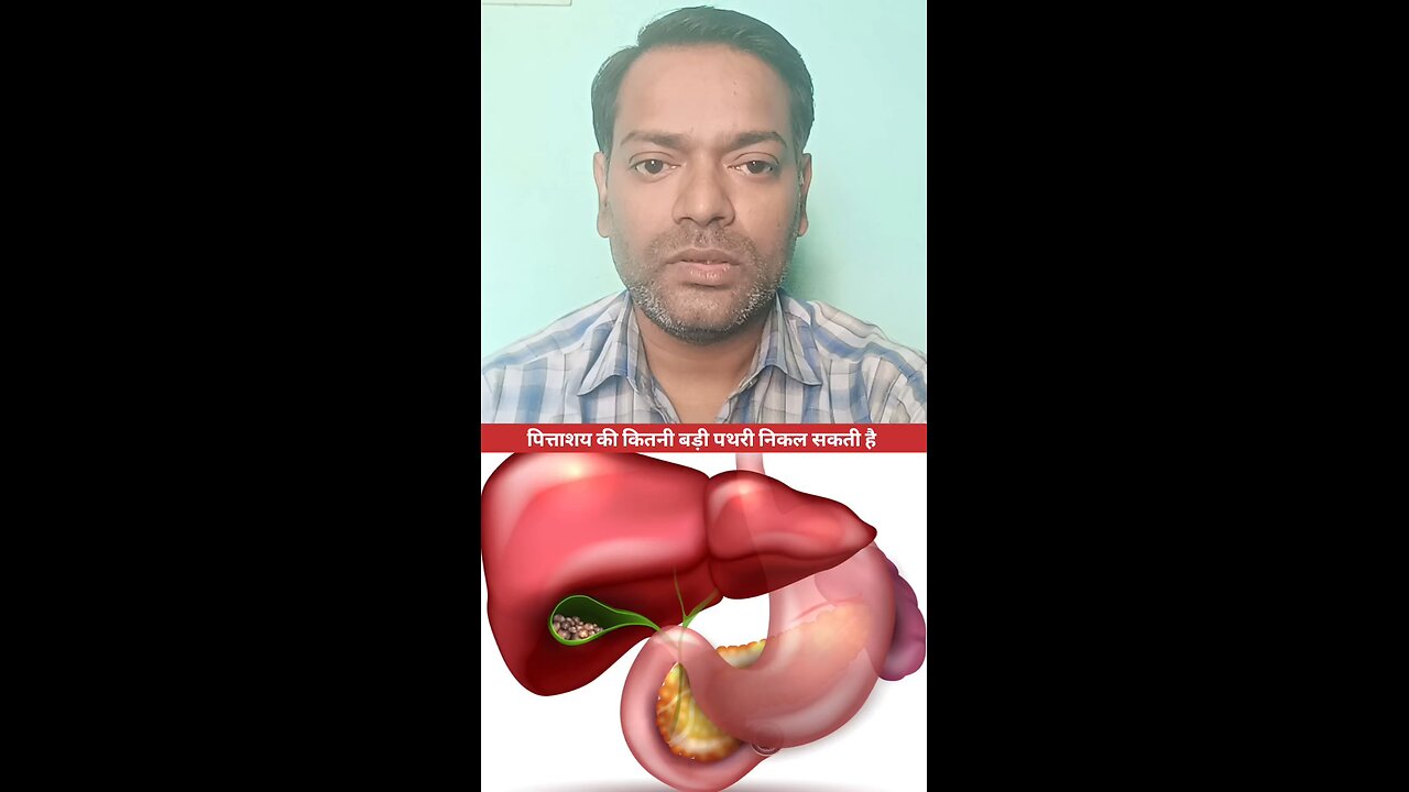 पित्ताशय की कितनी बड़ी पथरी निकल सकती है ।