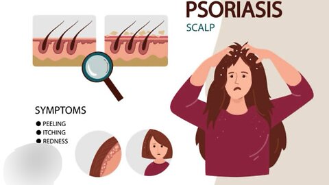Scratching dry itchy dandruff flakes #psoriasis #dandruff #asmr