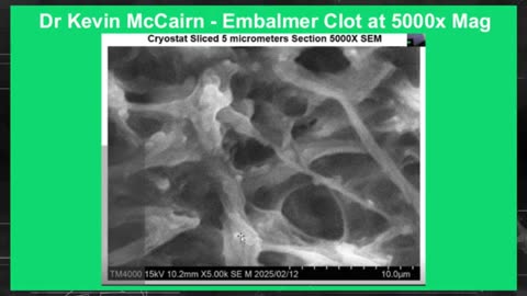 White Fibrous Clots Being Found Inside COVID Vaccinated Corpses & Living People