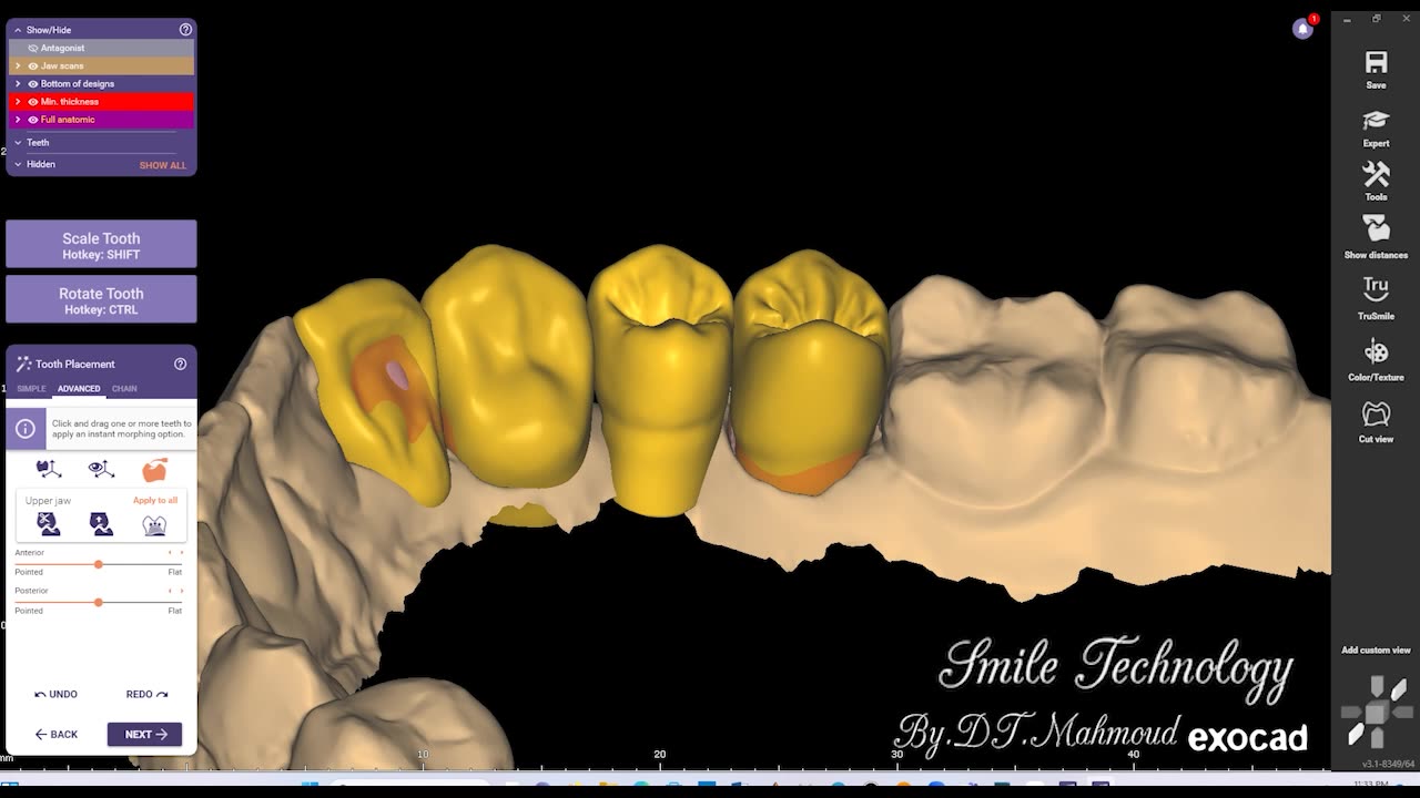 #design #naildesign #dental #dentaldesign #exocadexpert