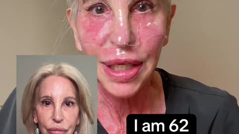 Hanheal NAD + Complex Meso Therapy Treatment Part 5