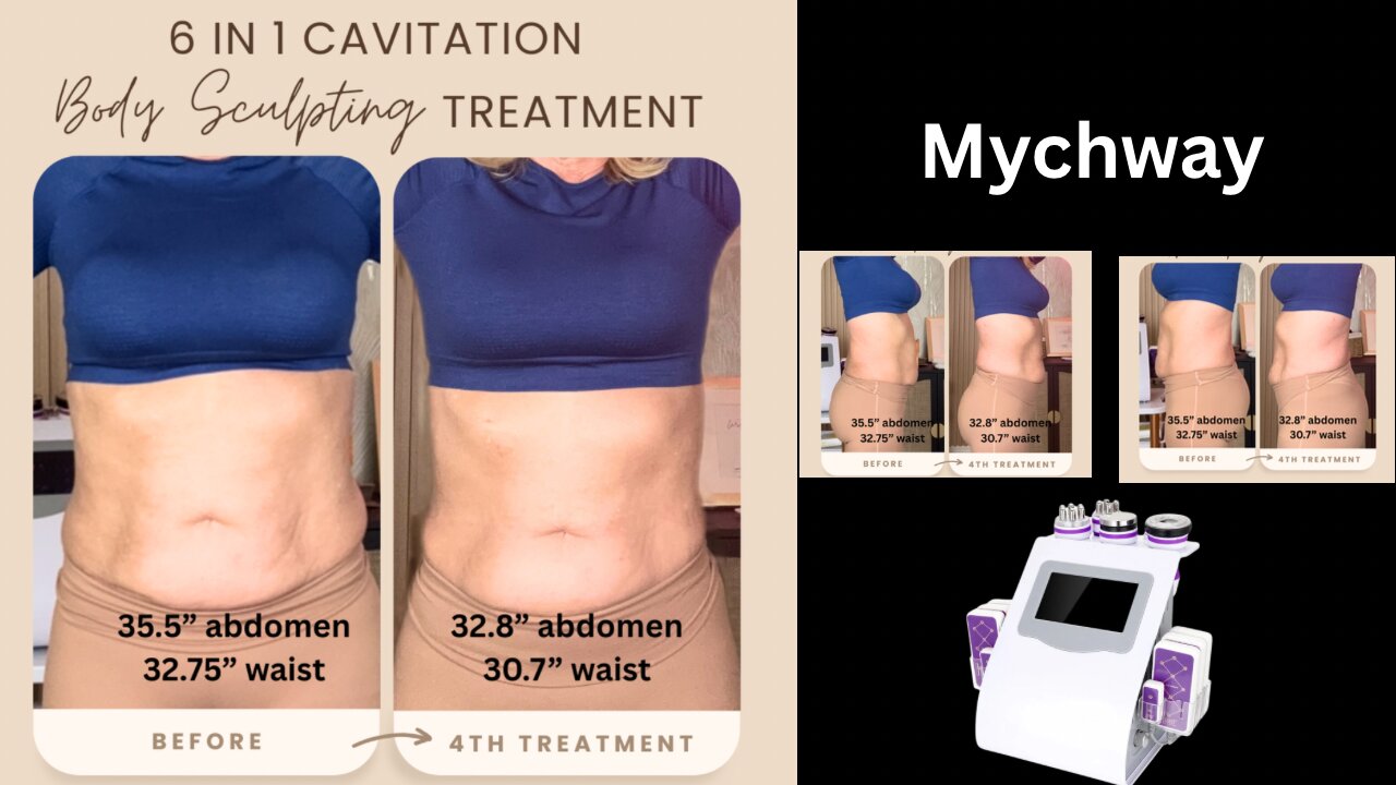 Wow! Check out my Results with Mychway 6in1 Cavitation - SASSY40 saves $40