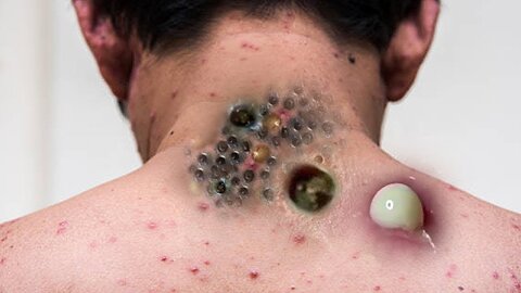 Really gross blackhead removal videos #1