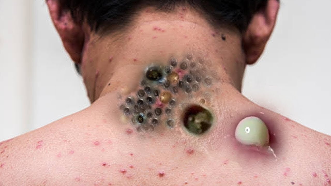 Really gross blackhead removal videos #1