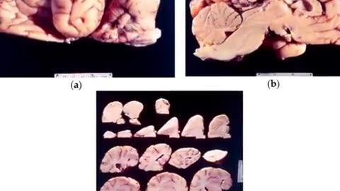 🚨🚨Warning Disturbing : How Kuru spreads