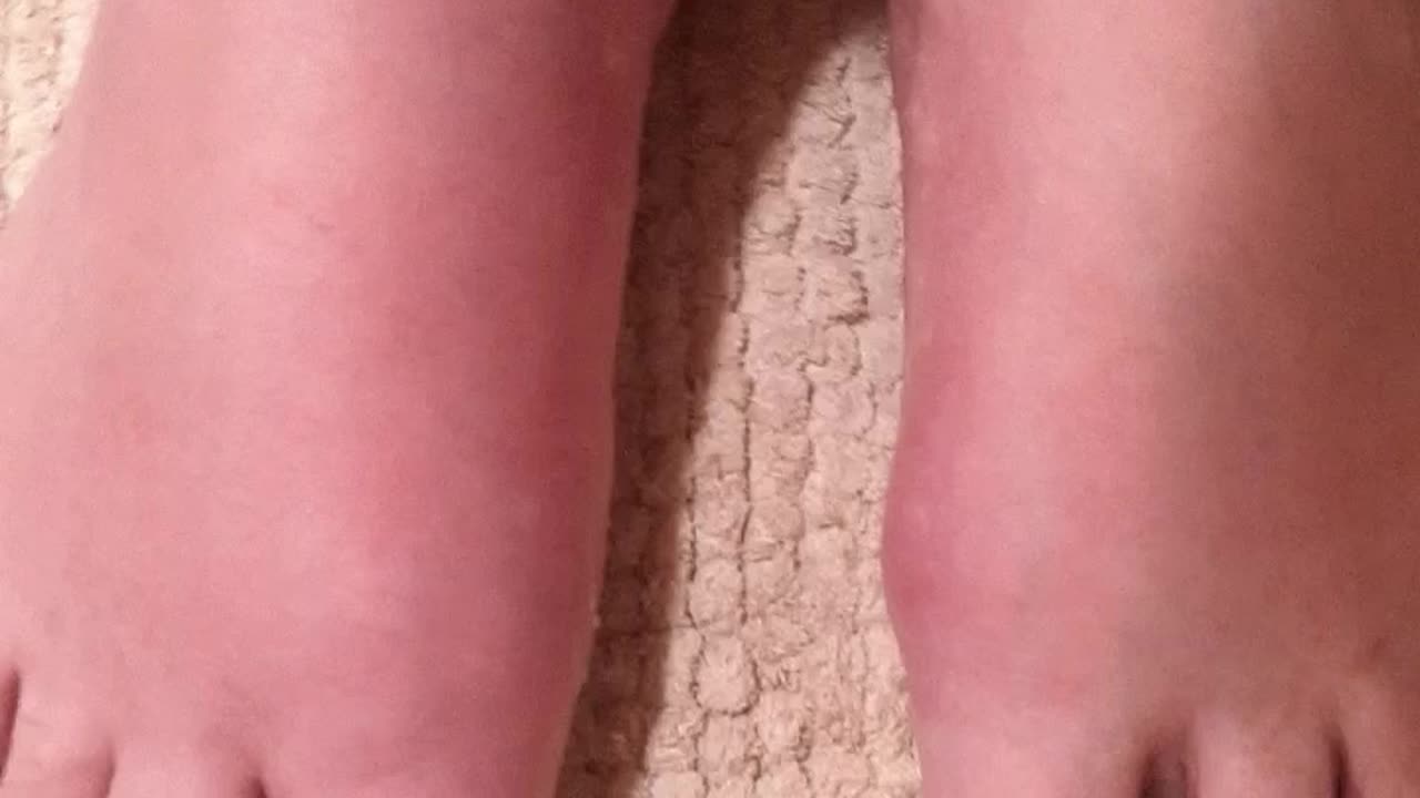 Lyme Disease - Limb swelling, fatigue, speech issues