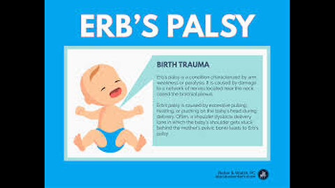 This is my Erb's palsy