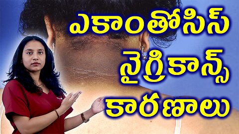 ఎకాంతోసిస్ నైగ్రికాన్స్ కారణాలు Causes for Acanthosis Nigricans in PCOS Treatment Cure Solution