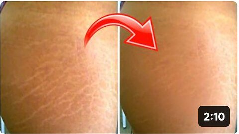 "Quickly Fade Stretch Marks with These 3 Mixed Ingredients"