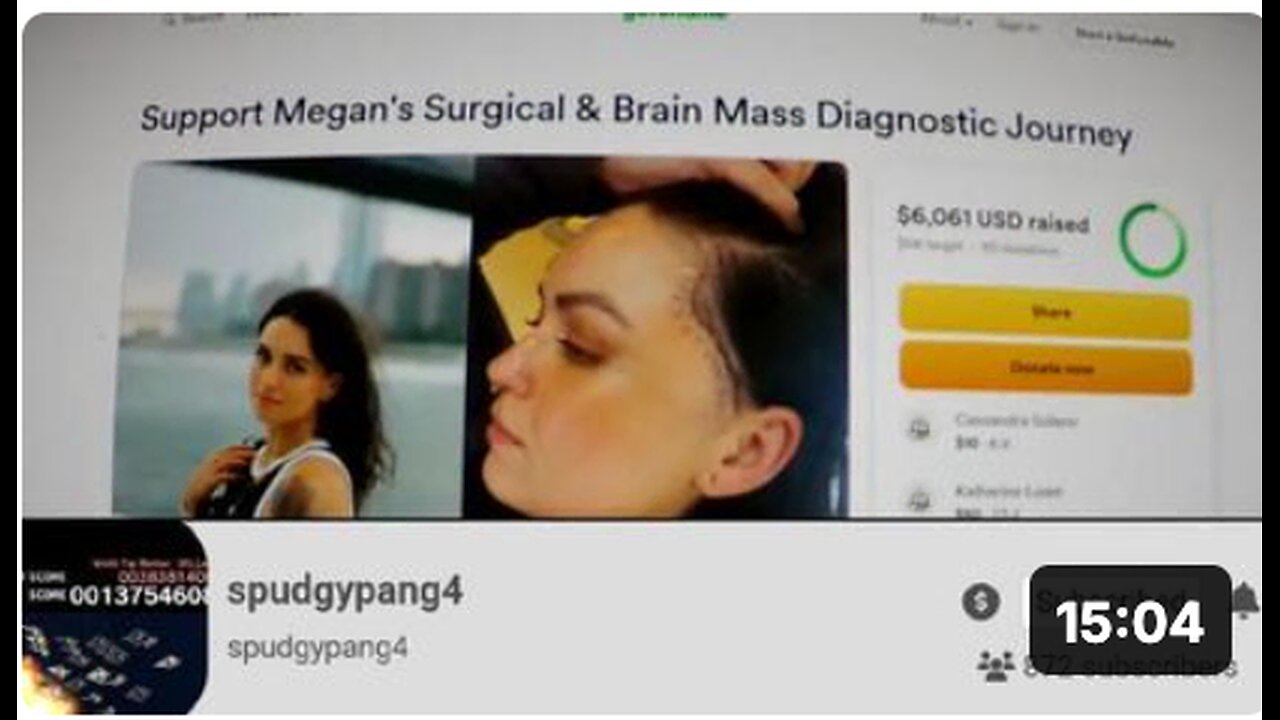 Craniotomy clot shot GoFraudmes - 1