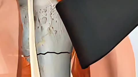 Humerus Fracture Surgery Explained in 15 Seconds – Watch the Full Recovery!