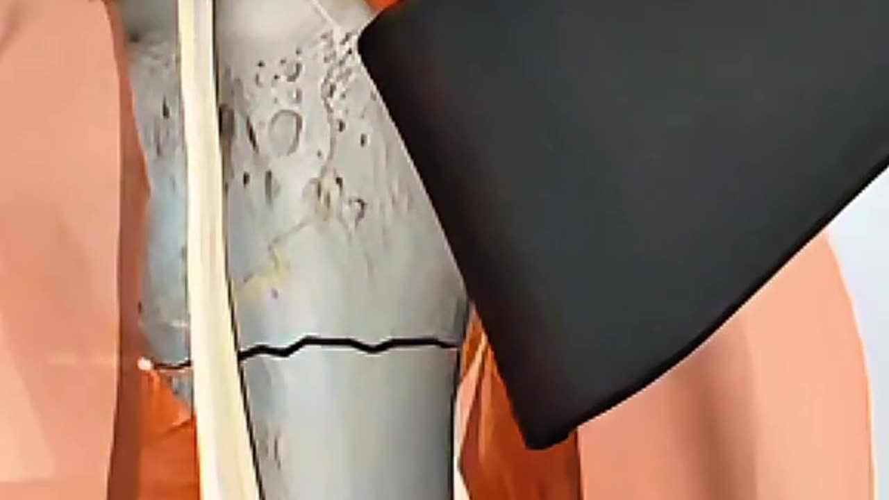 Humerus Fracture Surgery Explained in 15 Seconds – Watch the Full Recovery!