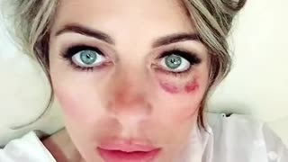 The “Black Eye” club,