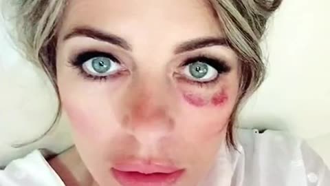 The “Black Eye” club,