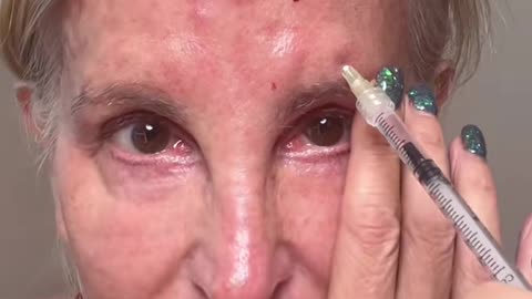 Hanheal PDRN Mesotherapy Part 2