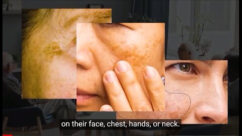 Dark Spots Caused By ‘Leaky Skin’ You Can Easily Clear By Doing This