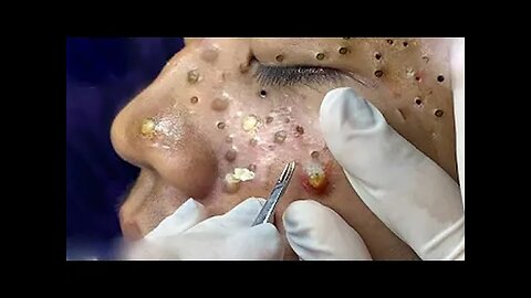 Big Cystic Acne Blackheads Extraction