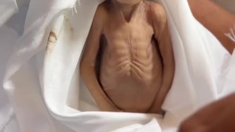 The infant Ghadir Brikeh (5 months old) passed away at Nasser Medical Complex