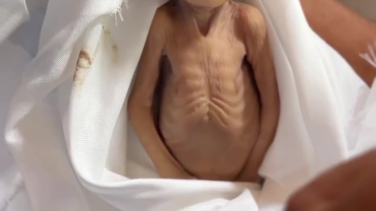 The infant Ghadir Brikeh (5 months old) passed away at Nasser Medical Complex