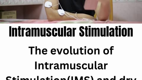 Intramuscular Stimulation (IMS) at Divinecare Physio