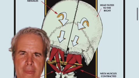 What can be the root cause of vertigo , brain fog, and headaches?