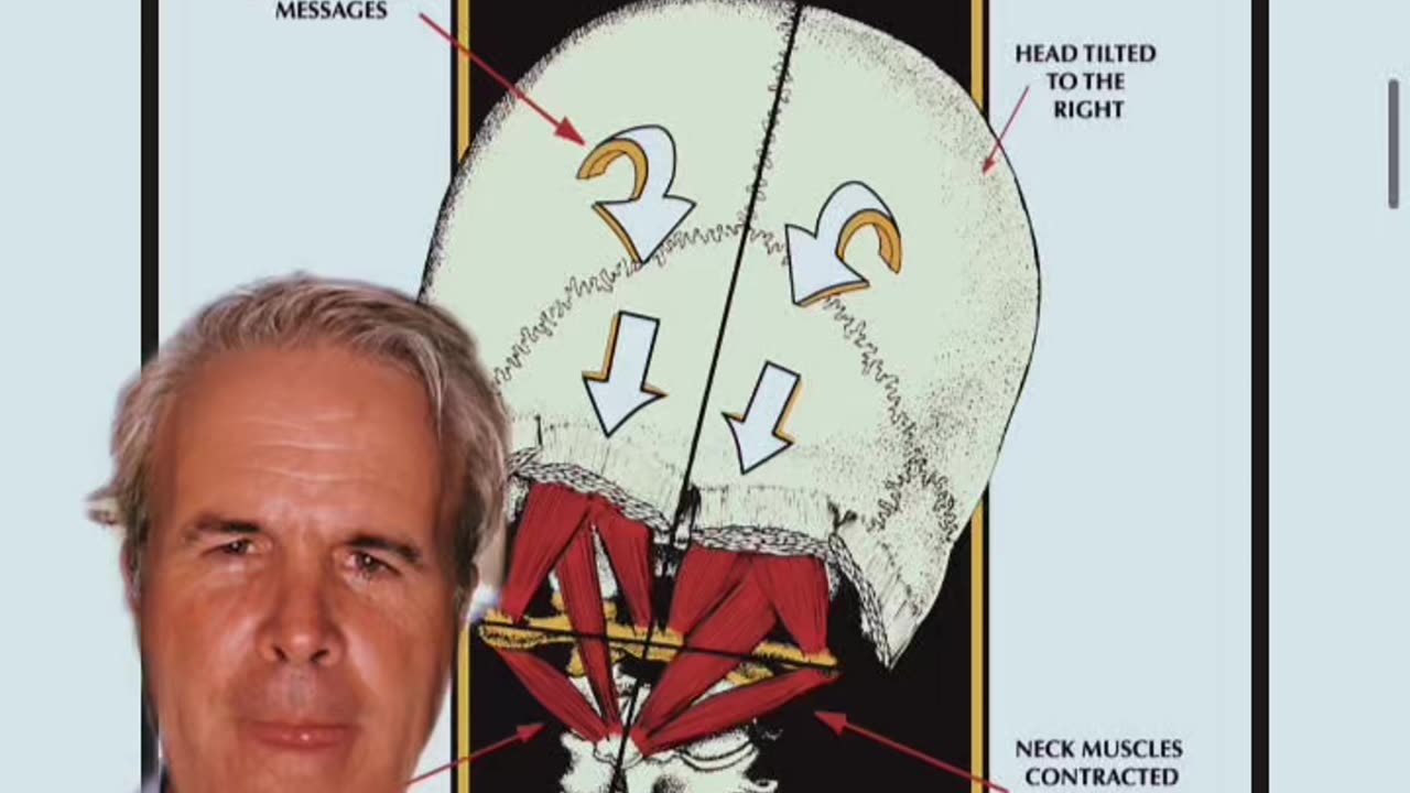 What can be the root cause of vertigo , brain fog, and headaches?