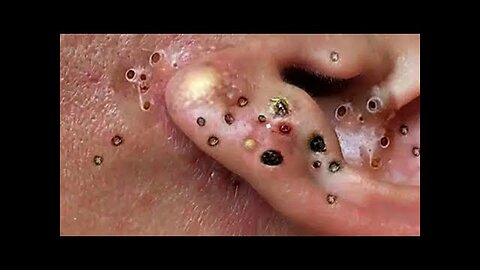 blackhead removal and Pimplepopper Spa relaxation #10129
