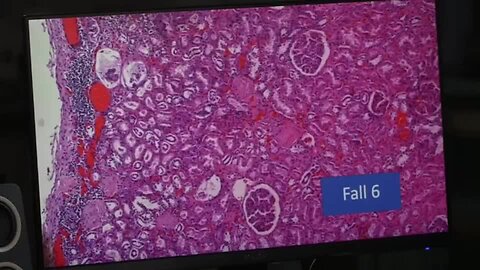 "Prof. Dr. Burkhardt Discusses Presence of Metal Parts in Covid Vaccines"