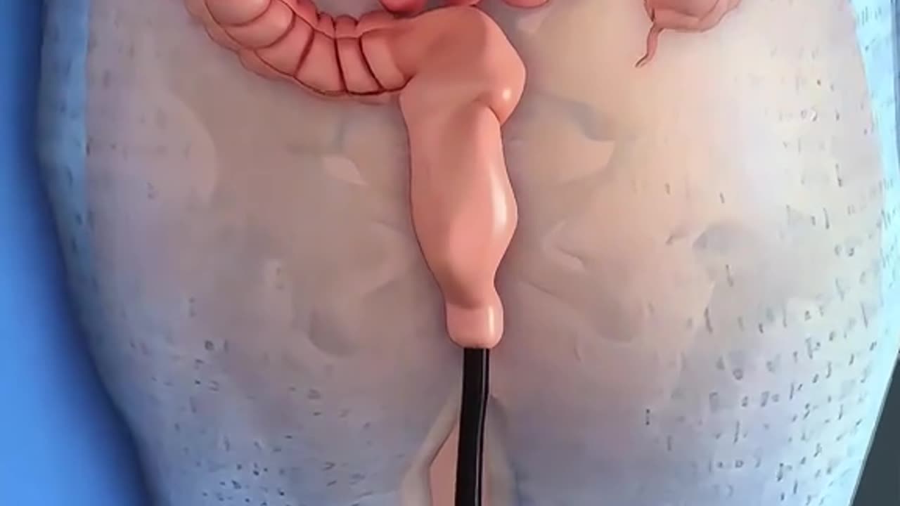 Polyps Removal Surgery 3D Animation (Polypectomy)