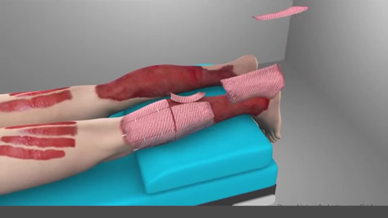 Skin Graft Procedure 3D Animation