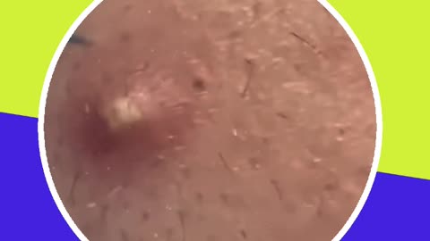 Pimple removal satisfying video (ASMR) #18 #shorts