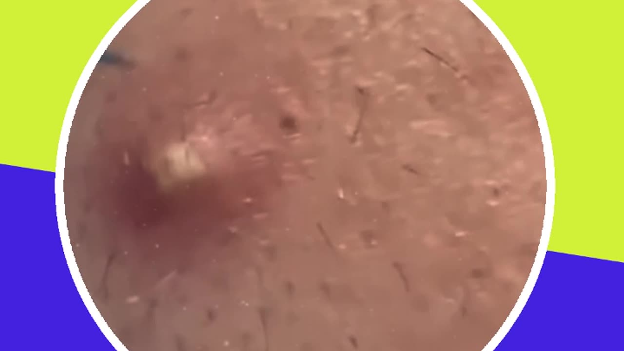 Pimple removal satisfying video (ASMR) #18 #shorts