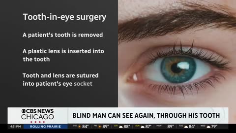 Blind man can see again, through his tooth