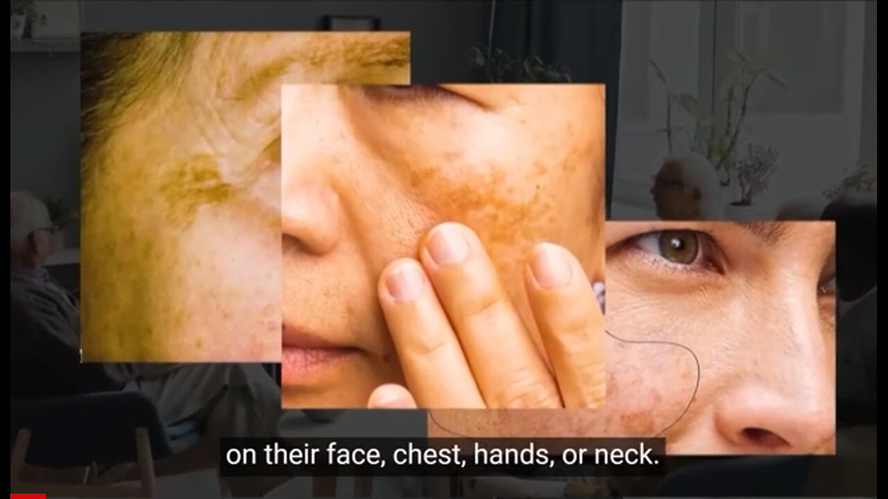 Dark Spots Caused By ‘Leaky Skin’ You Can Easily Clear By Doing This