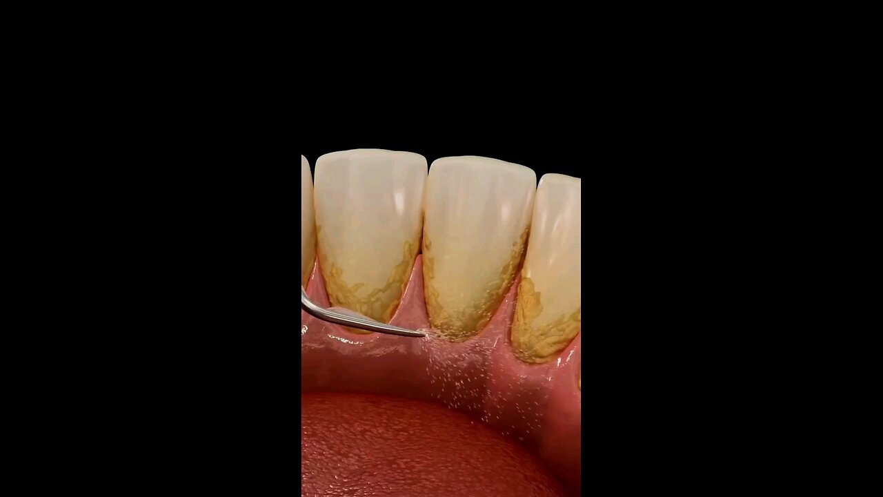 7 Second Trick To Rebuilds Your Teeth, Gums and Get Rid of Cavities Overnight