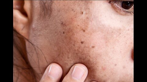 APPLY JUST 1 DROP... YOUR AGE SPOTS WIll BE ERASED FOREVER