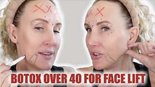 Should Your Botox Change as You Age? Botox Face Lifting Over 40
