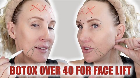 Should Your Botox Change as You Age? Botox Face Lifting Over 40