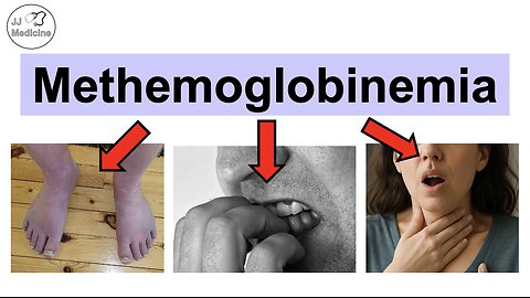 Methemoglobinemia (Condition from Processed Foods) Causes, Signs and Symptoms, Diagnosis, Treatment