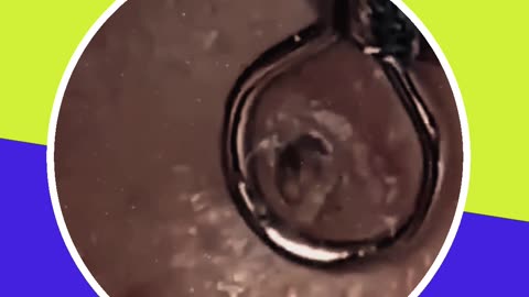 Blackhead removal new this week (ASMR) #11 #shorts