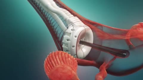 Cervical Cancer Treatment 3D Animation