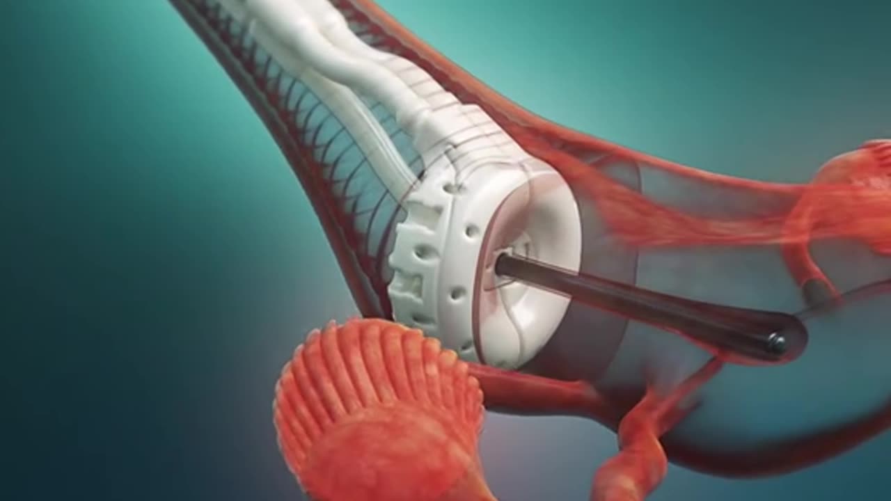 Cervical Cancer Treatment 3D Animation