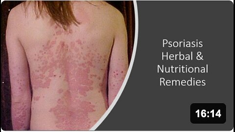 Psoriasis - Supplements, Herbs,Diet & Vitamins