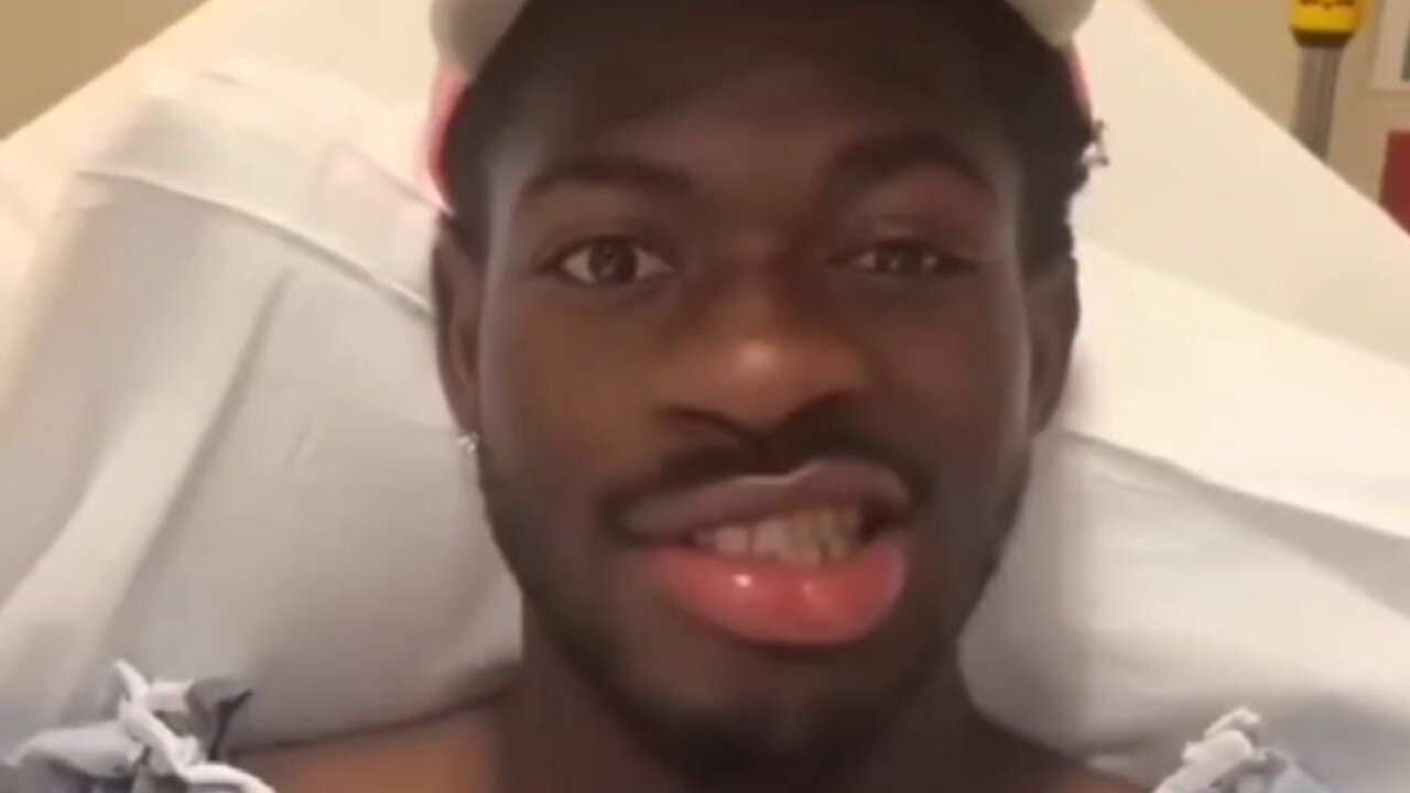 Lil Nas X suffering from Bell's Palsy