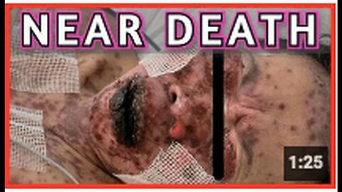 "New York Woman, 49, Contracts Severe Skin-Rotting Disorder After Pfizer mRNA Injection"
