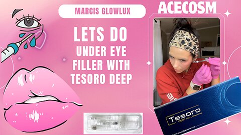 Lateral under eye filler Tesoro DEEP lido from ACECOSM with cannula